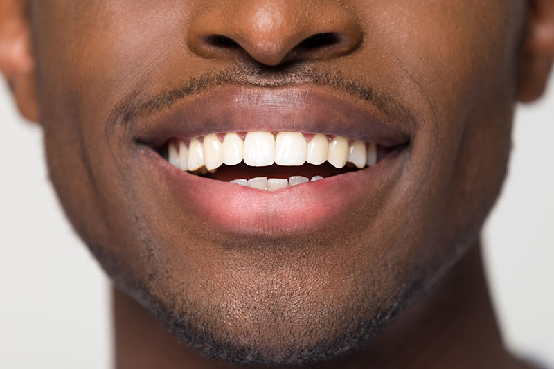 Dental Inlays/Onlays in Spring